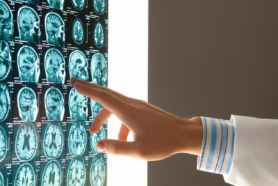 Doctor pointing at brain scan